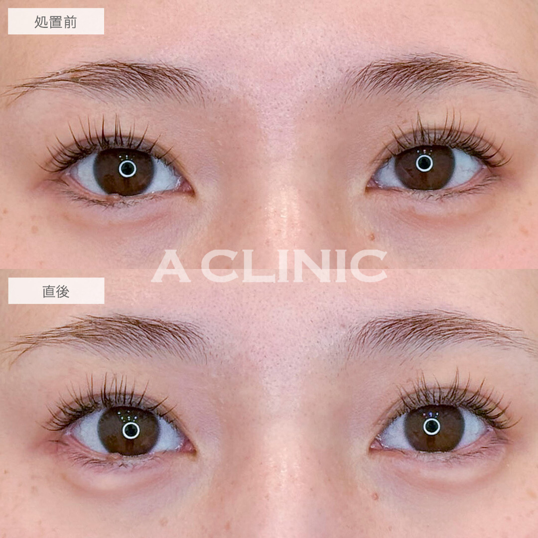 涙袋形成術(ヒアルロン酸)でメイク無しでもぷっくり可愛い涙袋に！処置前と直後の症例です(30代女性)