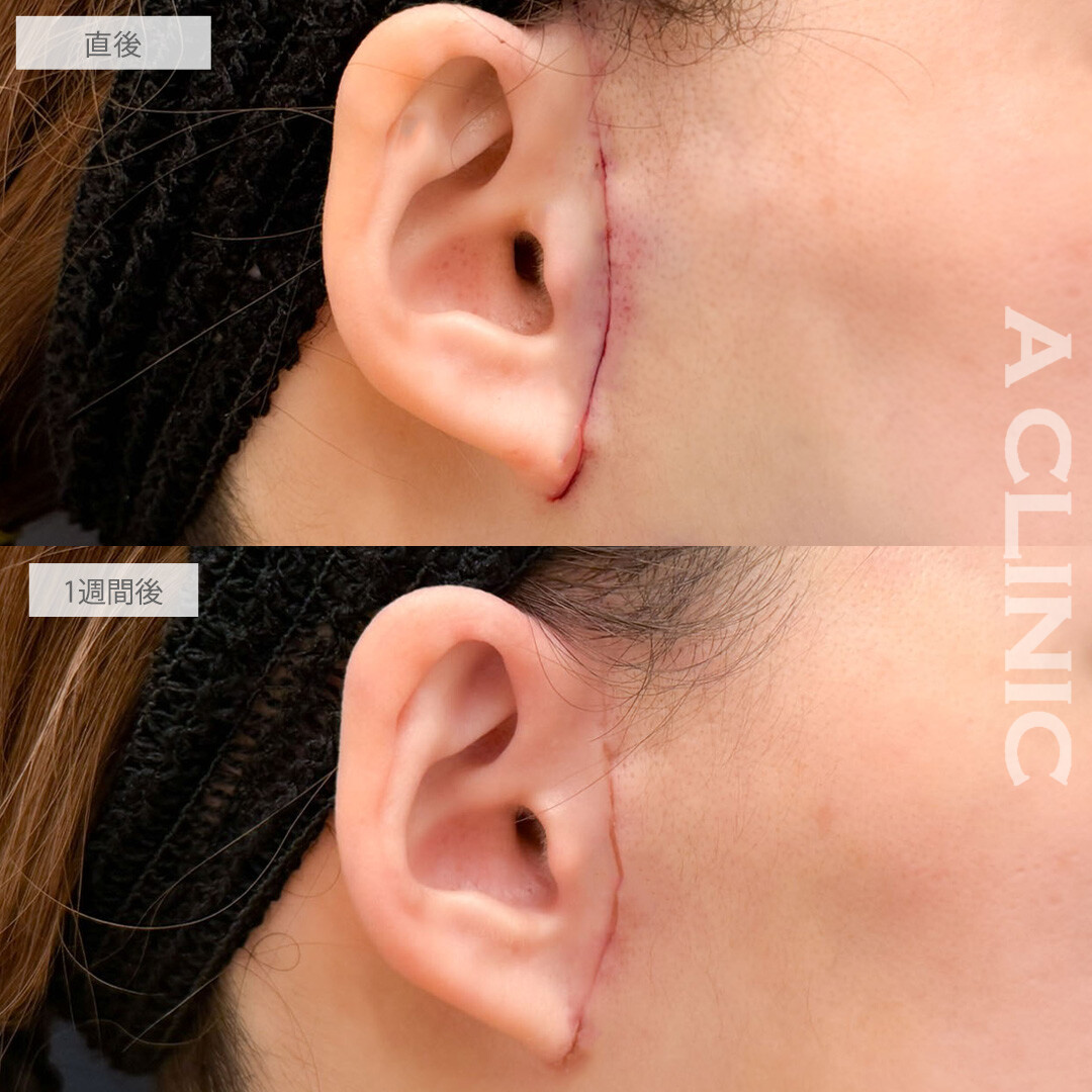 【直後の傷跡あり】A式ナゾラリフトと1day小顔脂肪吸引で気になる顔下半分のたるみ感を強力に引き上げすっきりしました！こちら処置前と1週間後の症例です(40代女性)