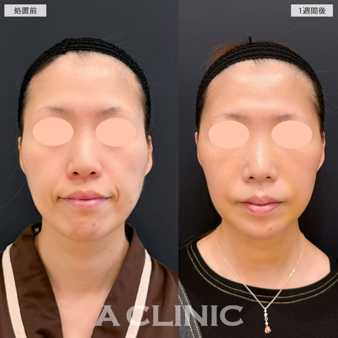 【直後の傷跡あり】A式ナゾラリフトと1day小顔脂肪吸引で気になる顔下半分のたるみ感を強力に引き上げすっきりしました！こちら処置前と1週間後の症例です(40代女性)
