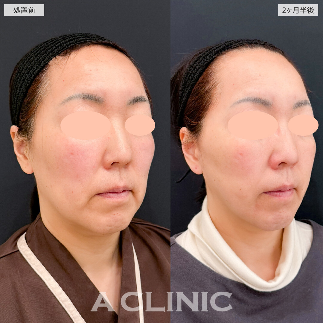 A式ナゾラリフトでたるみのお悩みを解決できます！こちら処置前と2ヶ月半後の症例です(50代女性)