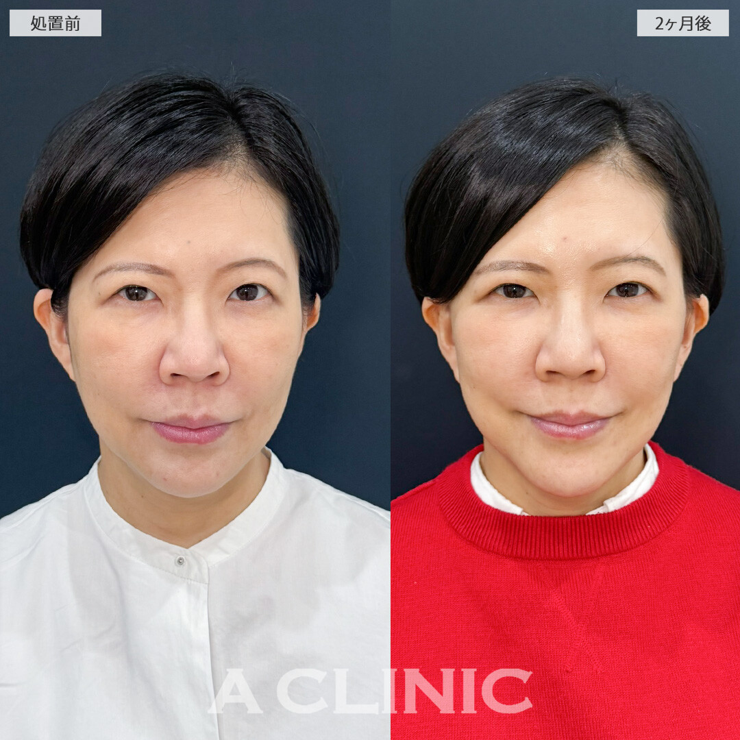 ナゾラビアルファット除去と切開リフトで横顔激変！こちらA式ナゾラリフトの処置前と2ヶ月後の症例です(50代女性)