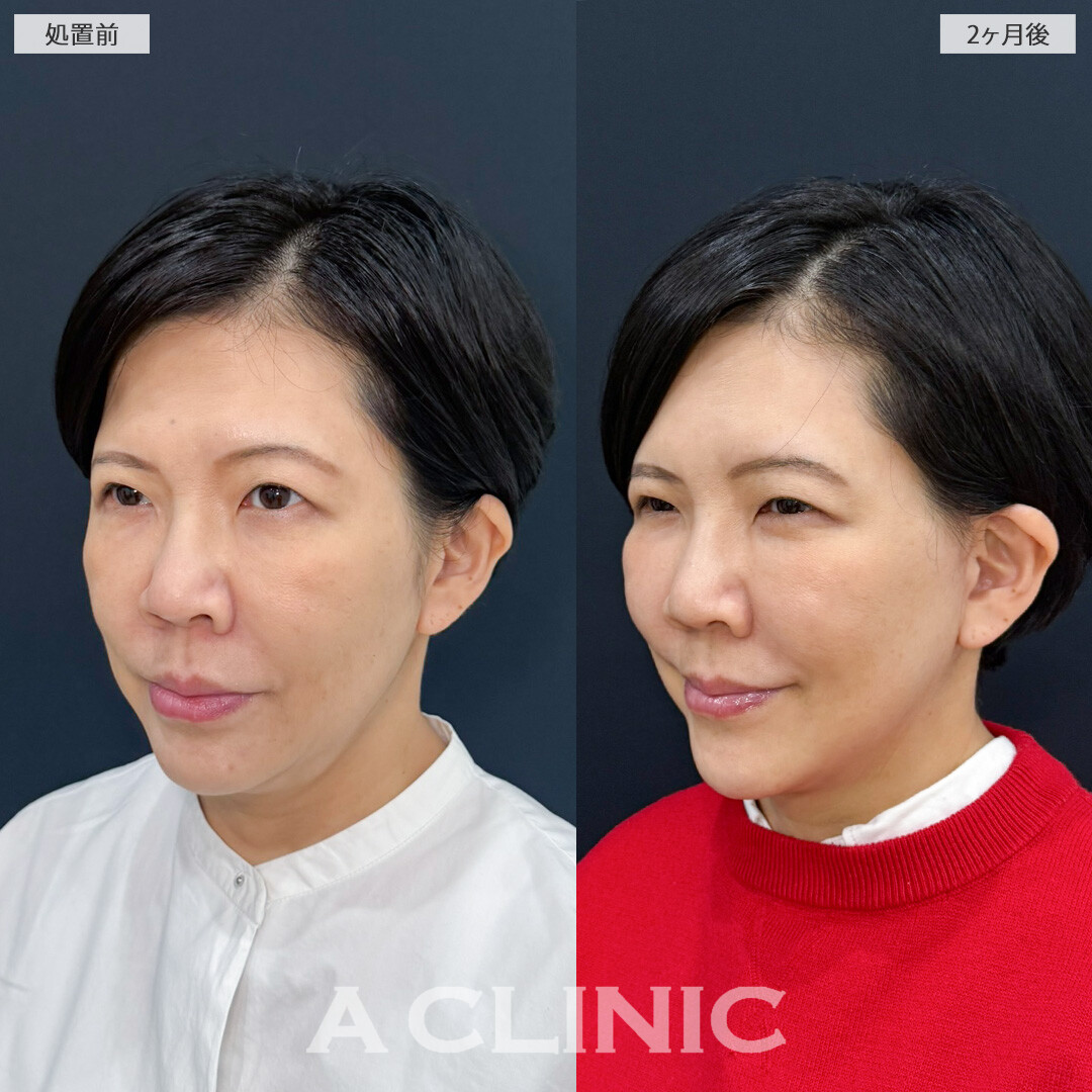 ナゾラビアルファット除去と切開リフトで横顔激変！こちらA式ナゾラリフトの処置前と2ヶ月後の症例です(50代女性)
