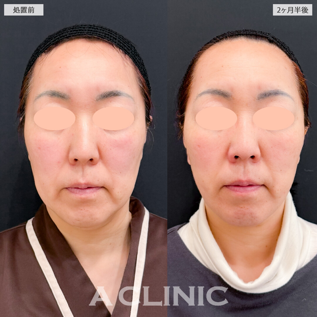 A式ナゾラリフトでたるみのお悩みを解決できます！こちら処置前と2ヶ月半後の症例です(50代女性)