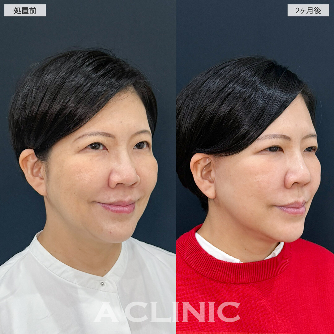 ナゾラビアルファット除去と切開リフトで横顔激変！こちらA式ナゾラリフトの処置前と2ヶ月後の症例です(50代女性)