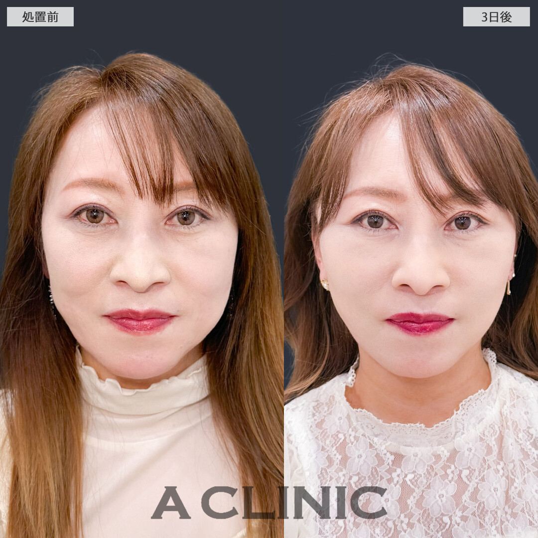 A式ナゾラリフトで若返りも老け見え予防も同時にケアできます！こちら処置前と3日後の症例です(50代女性)