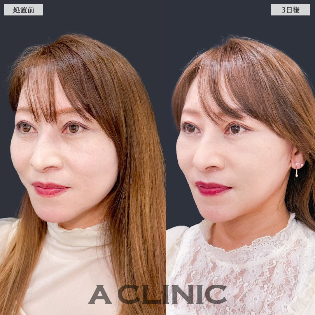 A式ナゾラリフトで若返りも老け見え予防も同時にケアできます！こちら処置前と3日後の症例です(50代女性)