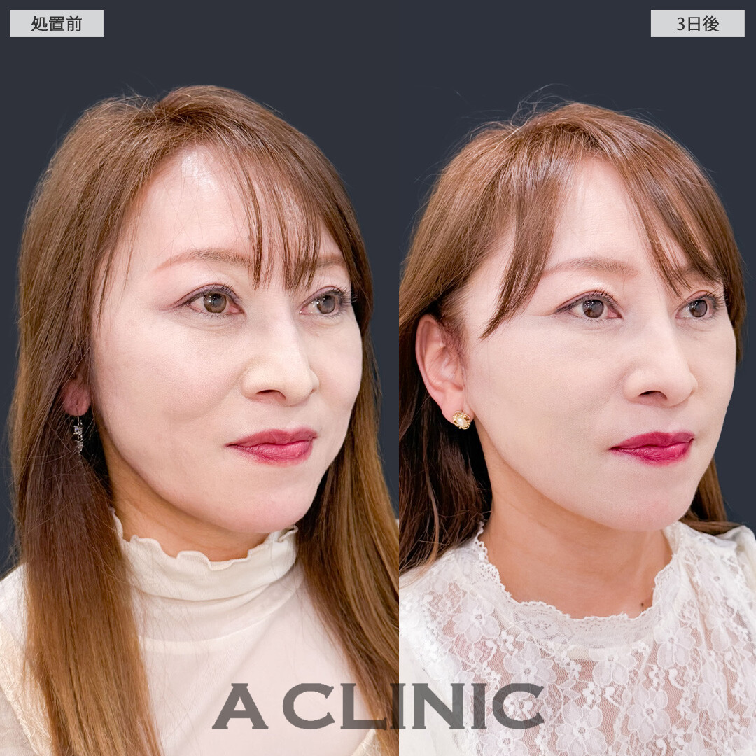 A式ナゾラリフトで若返りも老け見え予防も同時にケアできます！こちら処置前と3日後の症例です(50代女性)