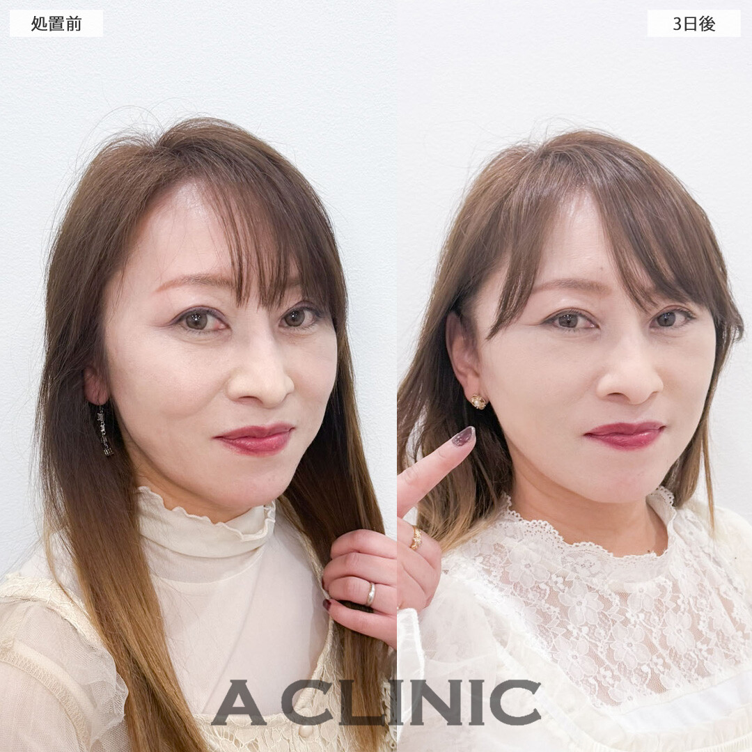 A式ナゾラリフトで若返りも老け見え予防も同時にケアできます！こちら処置前と3日後の症例です(50代女性)