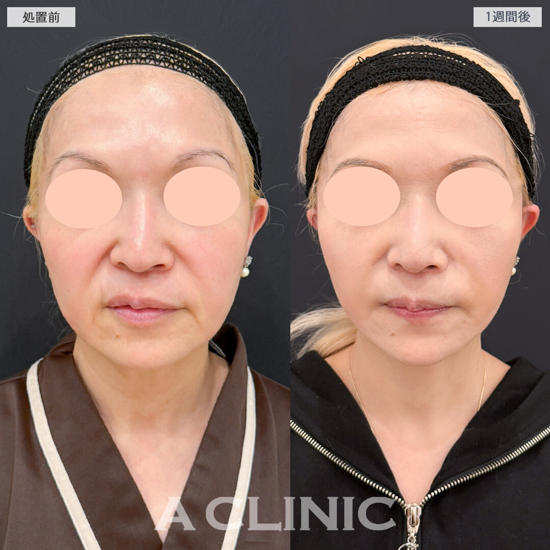 A式ナゾラリフトでたるんで下がってきた脂肪と皮膚を一気に解消！処置前と1週間後の症例です(50代女性)