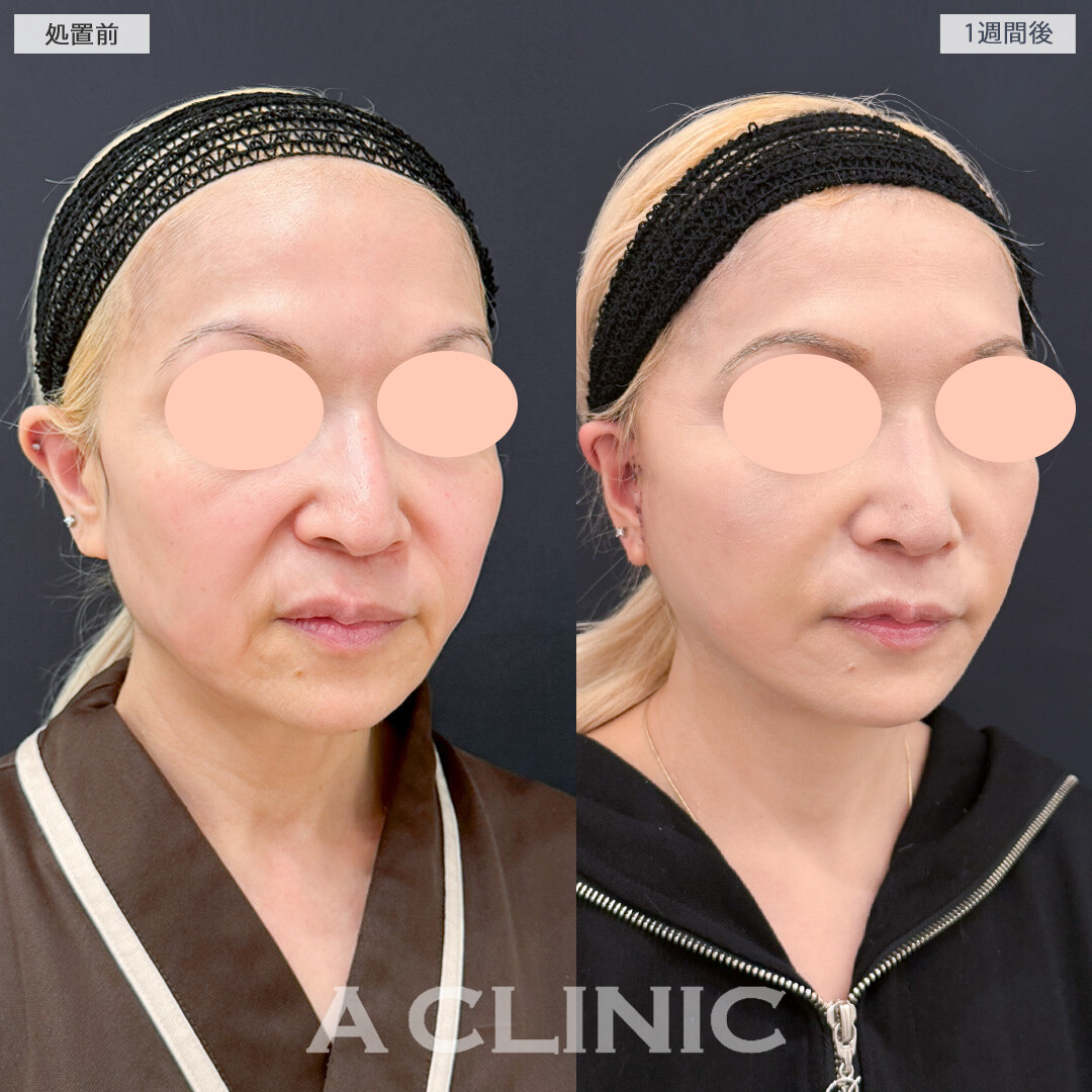 A式ナゾラリフトでたるんで下がってきた脂肪と皮膚を一気に解消！処置前と1週間後の症例です(50代女性)