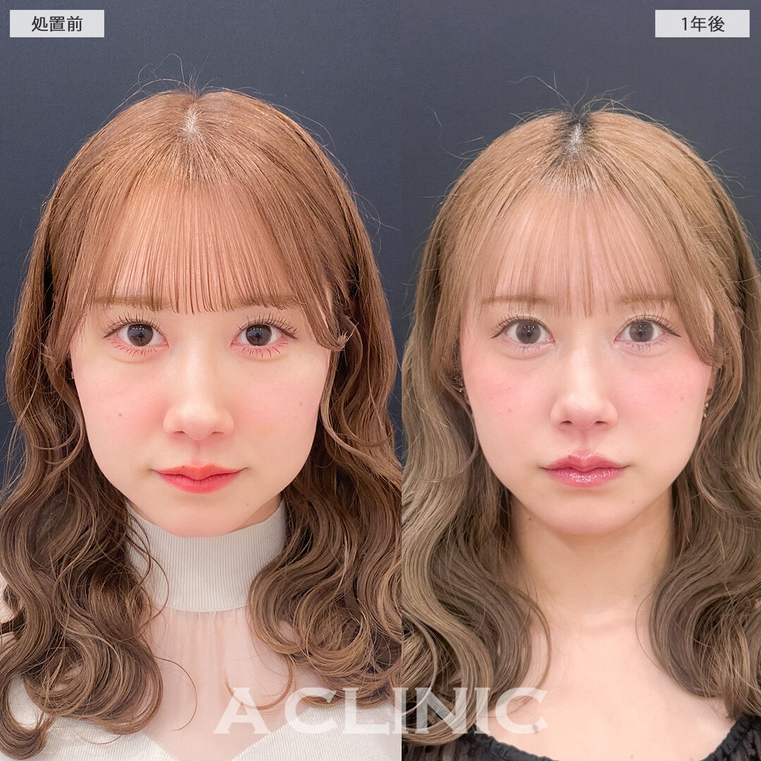 1day小顔脂肪吸引で1年後も小顔継続！こちら処置前と1年後の症例です(30代女性)