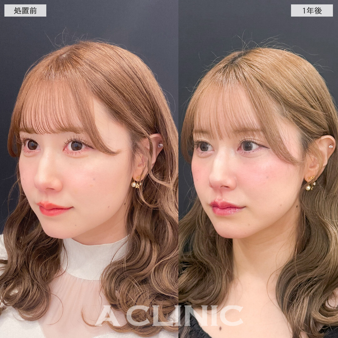 1day小顔脂肪吸引で1年後も小顔継続！こちら処置前と1年後の症例です(30代女性)