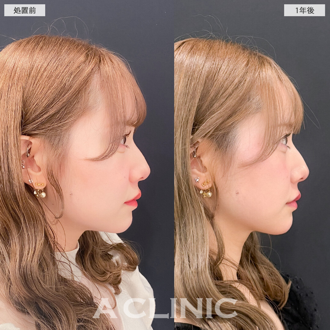 1day小顔脂肪吸引で1年後も小顔継続！こちら処置前と1年後の症例です(30代女性)