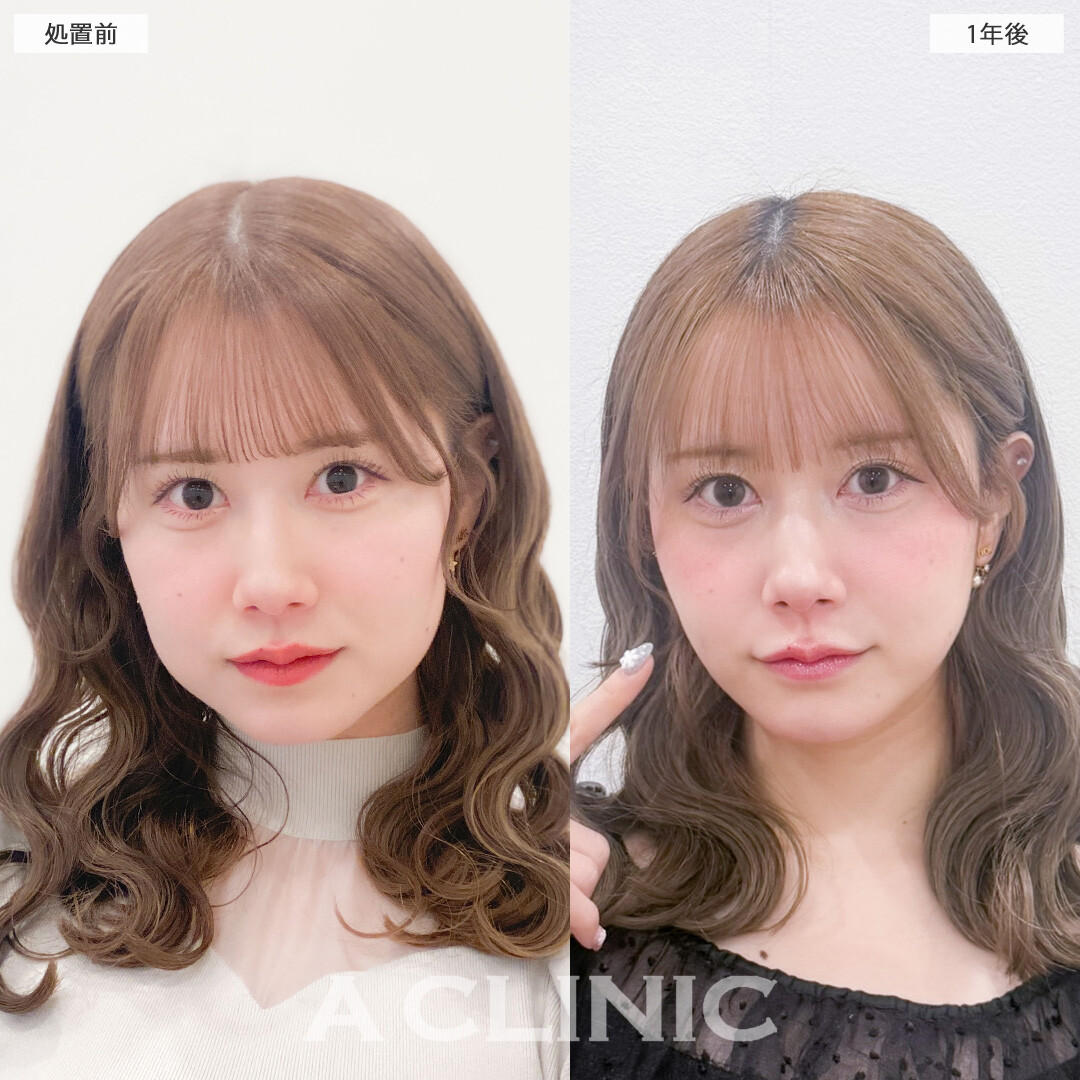 1day小顔脂肪吸引で1年後も小顔継続！こちら処置前と1年後の症例です(30代女性)