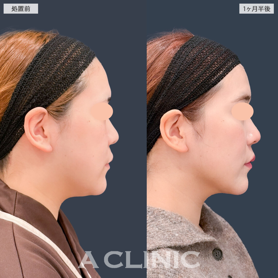 1day小顔脂肪吸引でアゴ下すっきりコンプレックスを解消！こちら処置前と1ヶ月半後の症例です(20代女性)