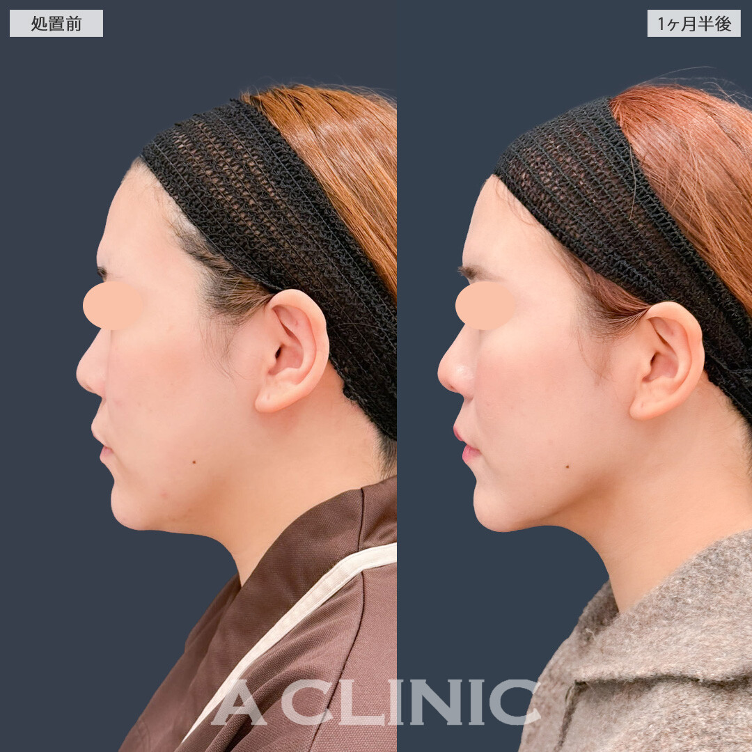 1day小顔脂肪吸引でアゴ下すっきりコンプレックスを解消！こちら処置前と1ヶ月半後の症例です(20代女性)
