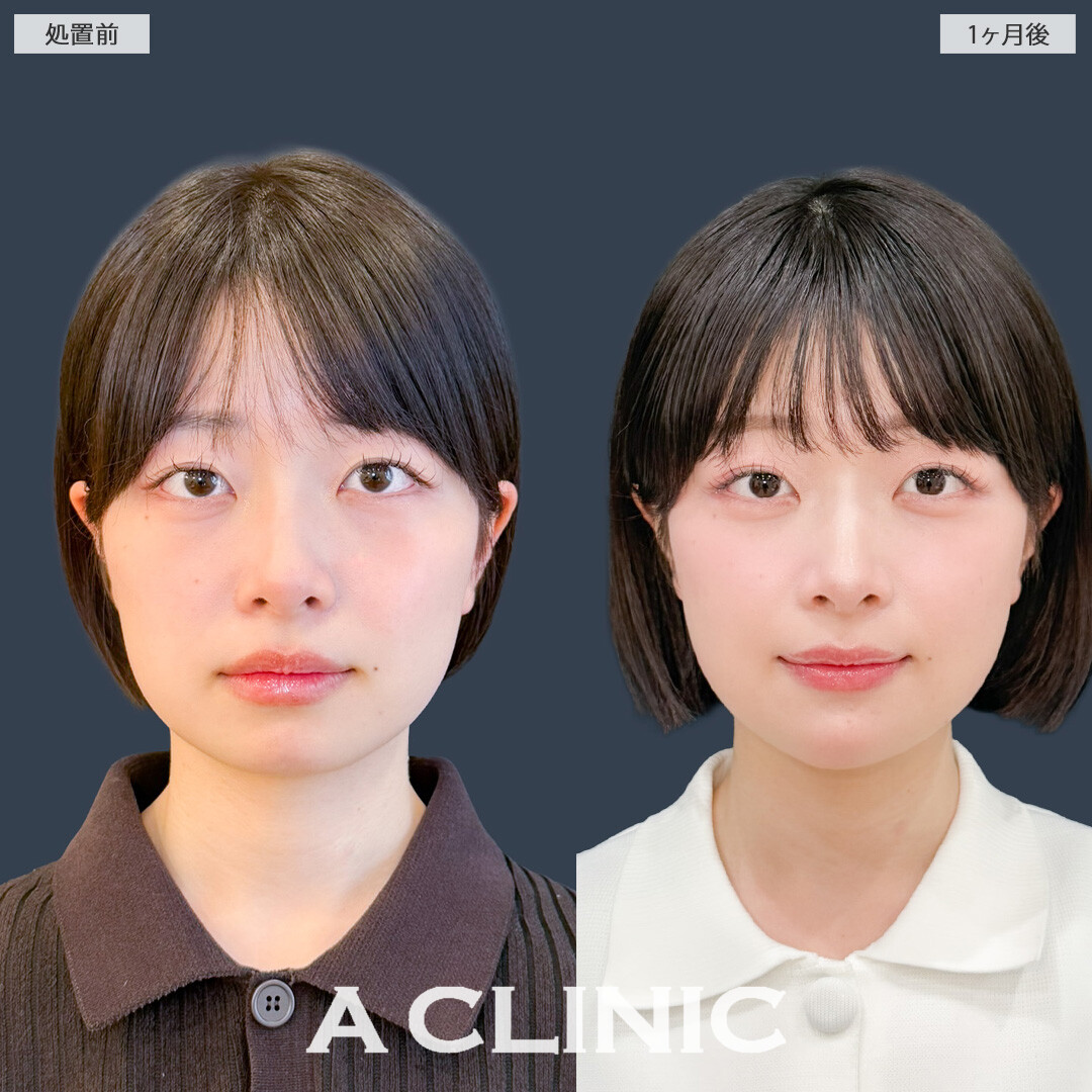 1day小顔脂肪吸引で自然に小顔になってかわいくなりました！こちら処置前と1か月後の症例です(20代女性)