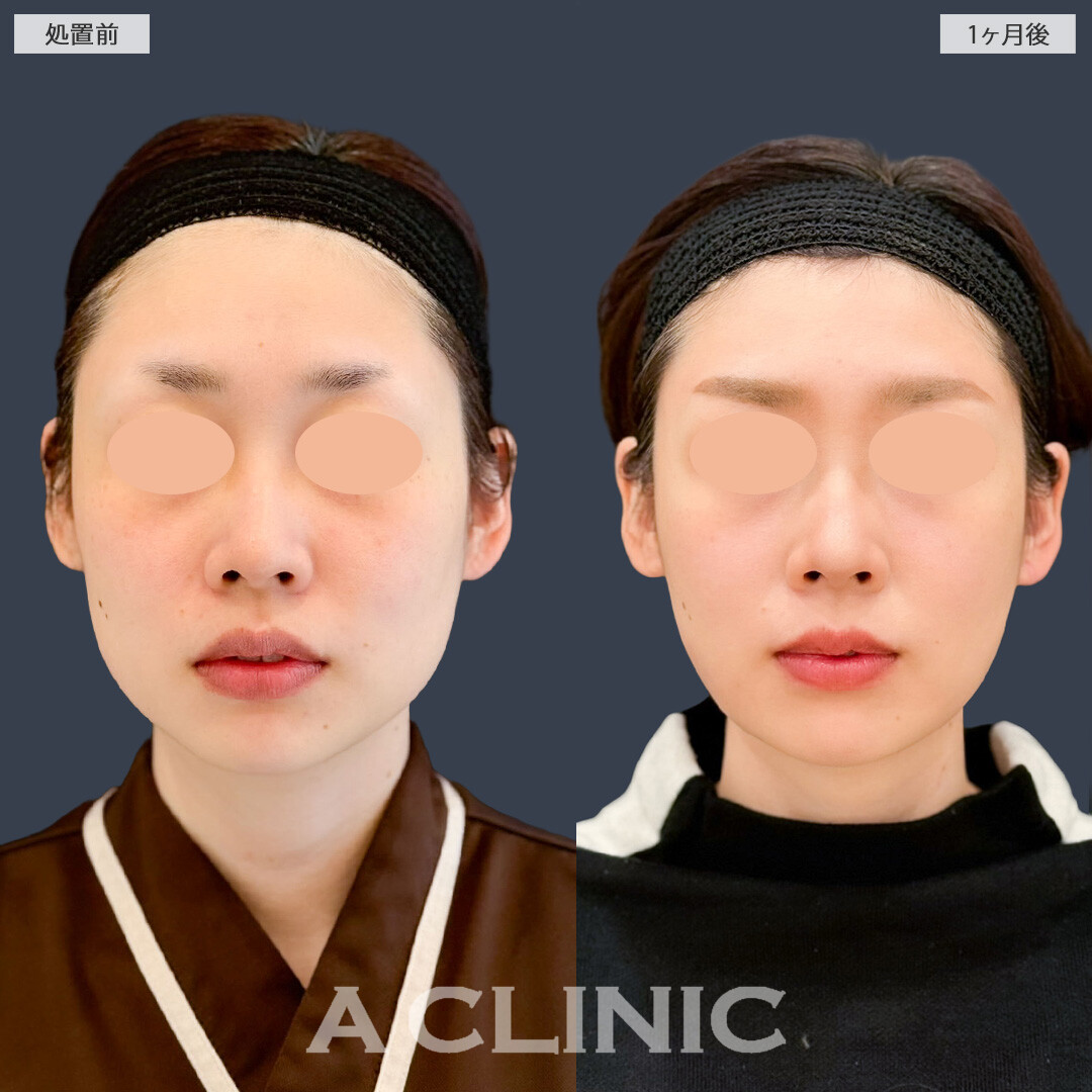 1day小顔脂肪吸引で輪郭きれいにアゴ下の脂肪も減りました！こちら処置前と1ヶ月後の症例です(30代女性)