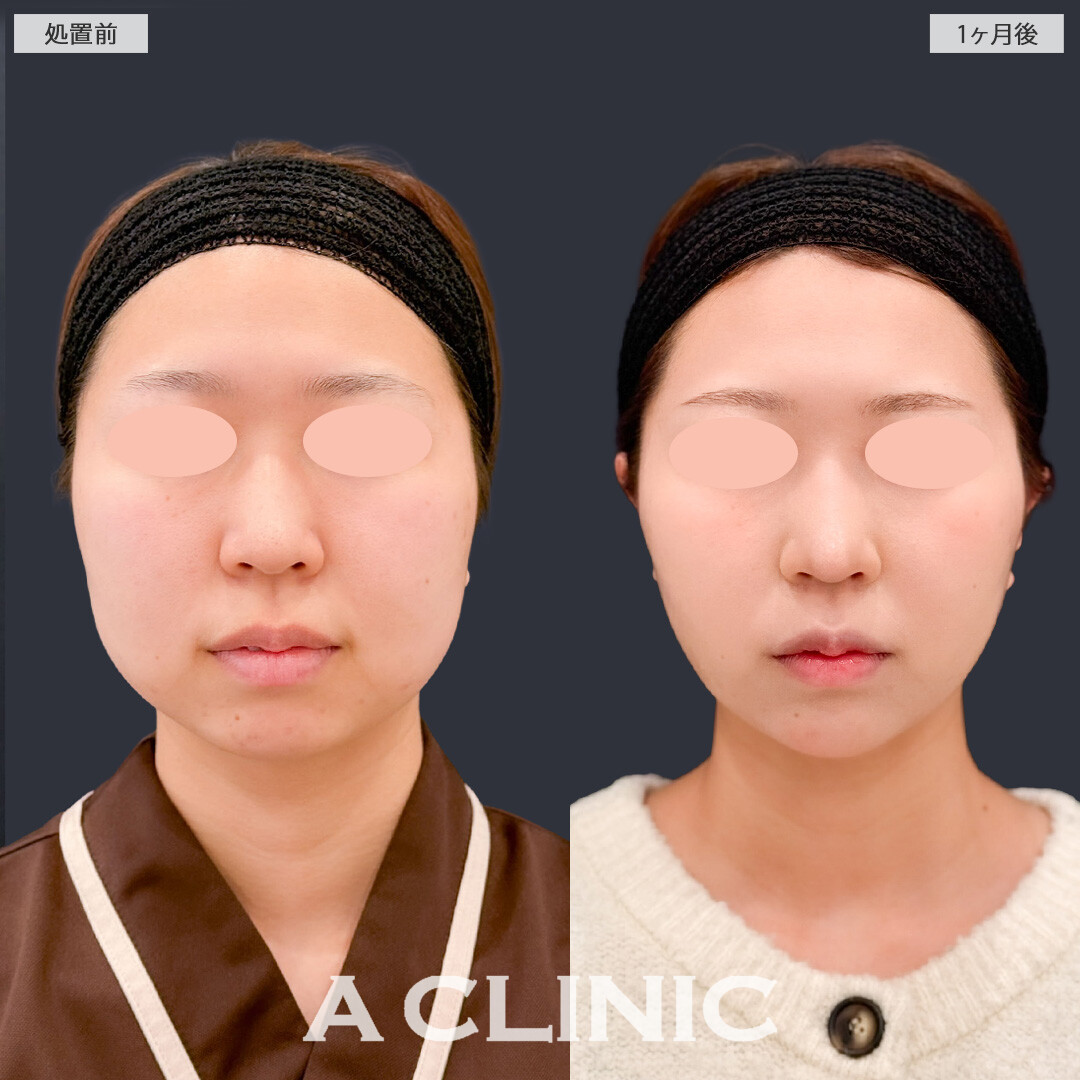 1day小顔脂肪吸引とバッカルファット除去術で必要な脂肪は残したまましっかりきれいな小顔になれました！こちら処置前と1か月後の症例です(20代女性)
