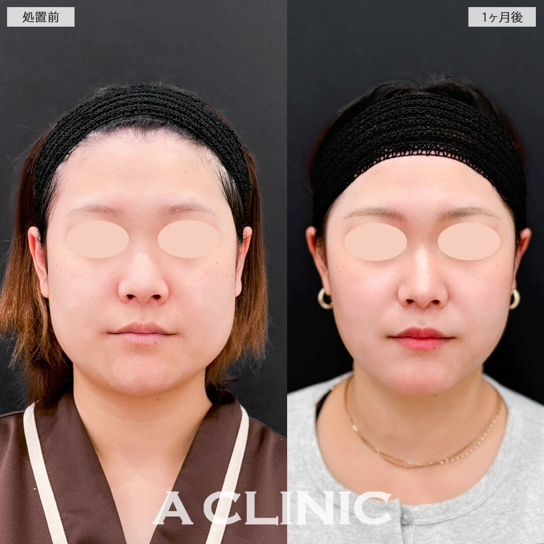 1day小顔脂肪吸引とバッカルファット除去術で加工後のような理想のフェイスラインに！こちら処置前と1か月後の症例です(20代女性)