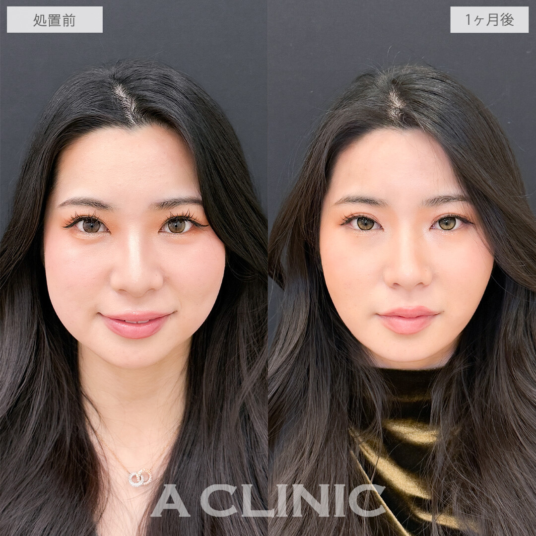 1day小顔脂肪吸引とバッカルファット除去術でお顔のボリューム感を落としてさらに美人に！こちら処置前と1か月後の症例です(20代女性)