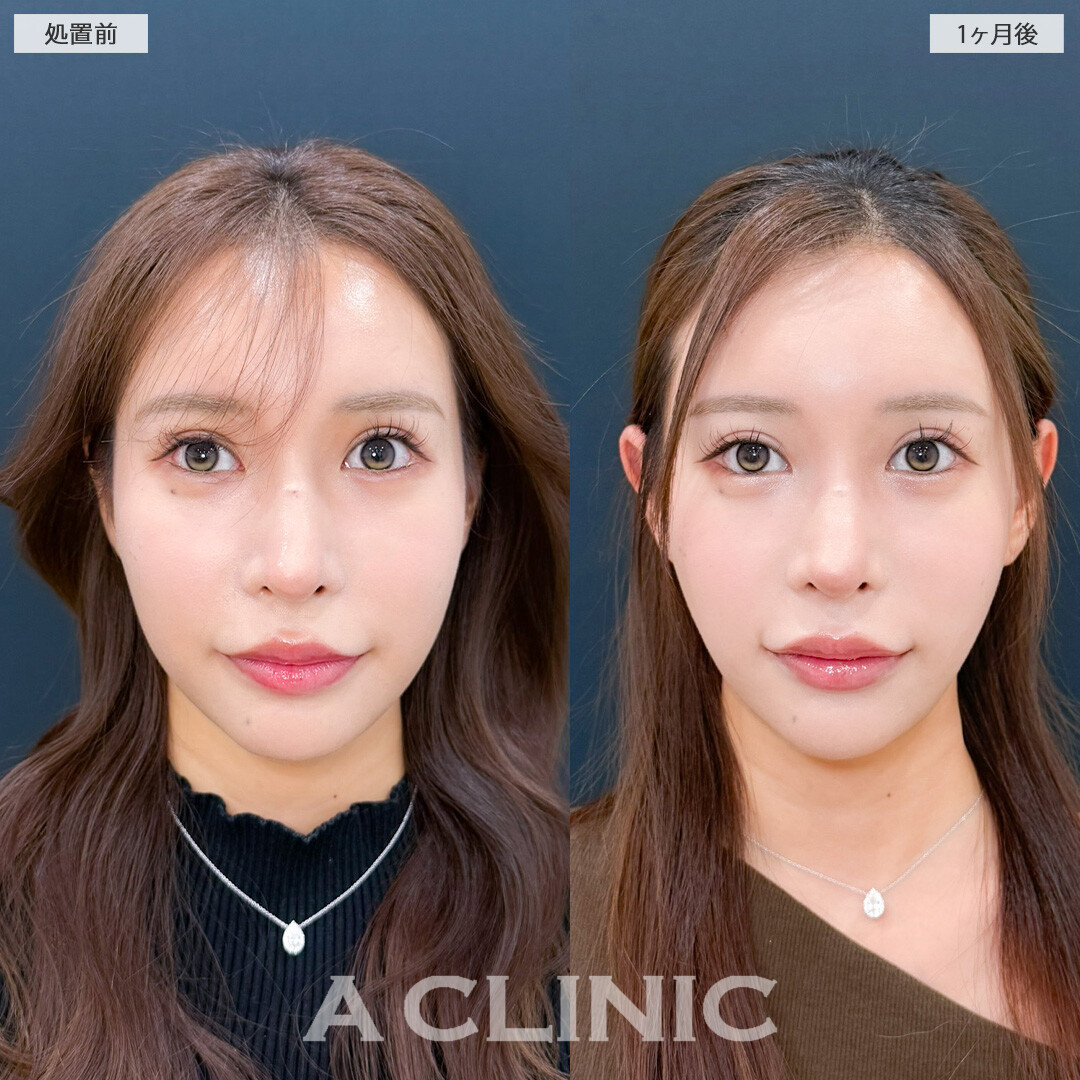 1day小顔脂肪吸引で美しいVフェイスに！こちら処置前と1ヶ月後の症例です(20代女性)