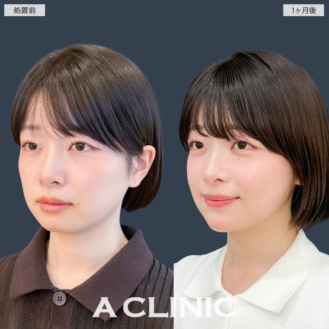 1day小顔脂肪吸引で自然に小顔になってかわいくなりました！こちら処置前と1か月後の症例です(20代女性)