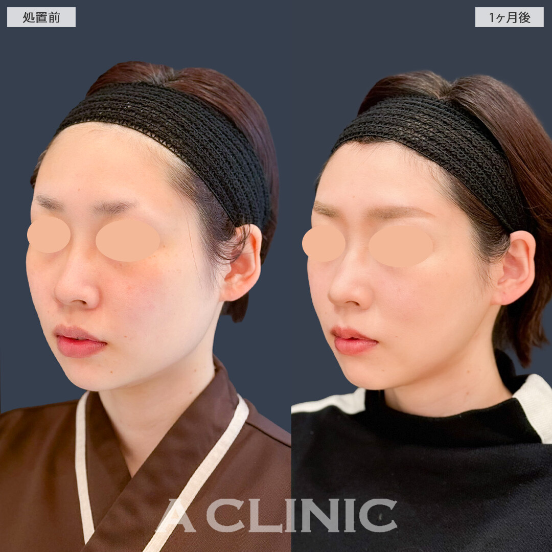 1day小顔脂肪吸引で輪郭きれいにアゴ下の脂肪も減りました！こちら処置前と1ヶ月後の症例です(30代女性)