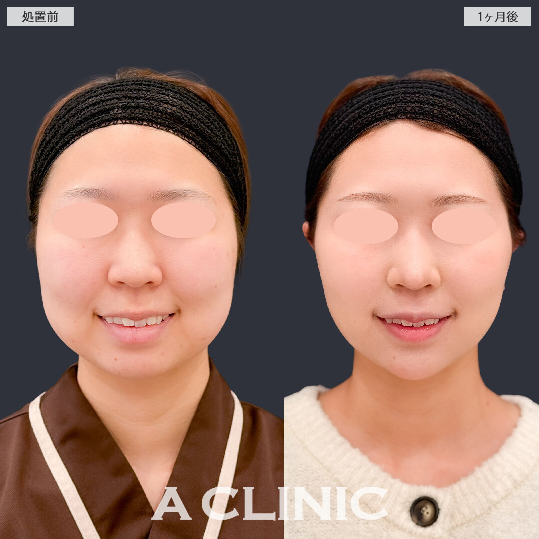 1day小顔脂肪吸引とバッカルファット除去術で必要な脂肪は残したまましっかりきれいな小顔になれました！こちら処置前と1か月後の症例です(20代女性)