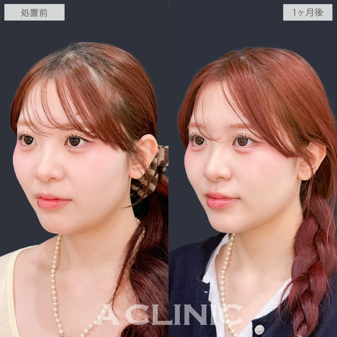 1day小顔脂肪吸引でフェイスラインが整って洗練された可愛さに！こちら処置前と1か月後の症例です(20代女性)