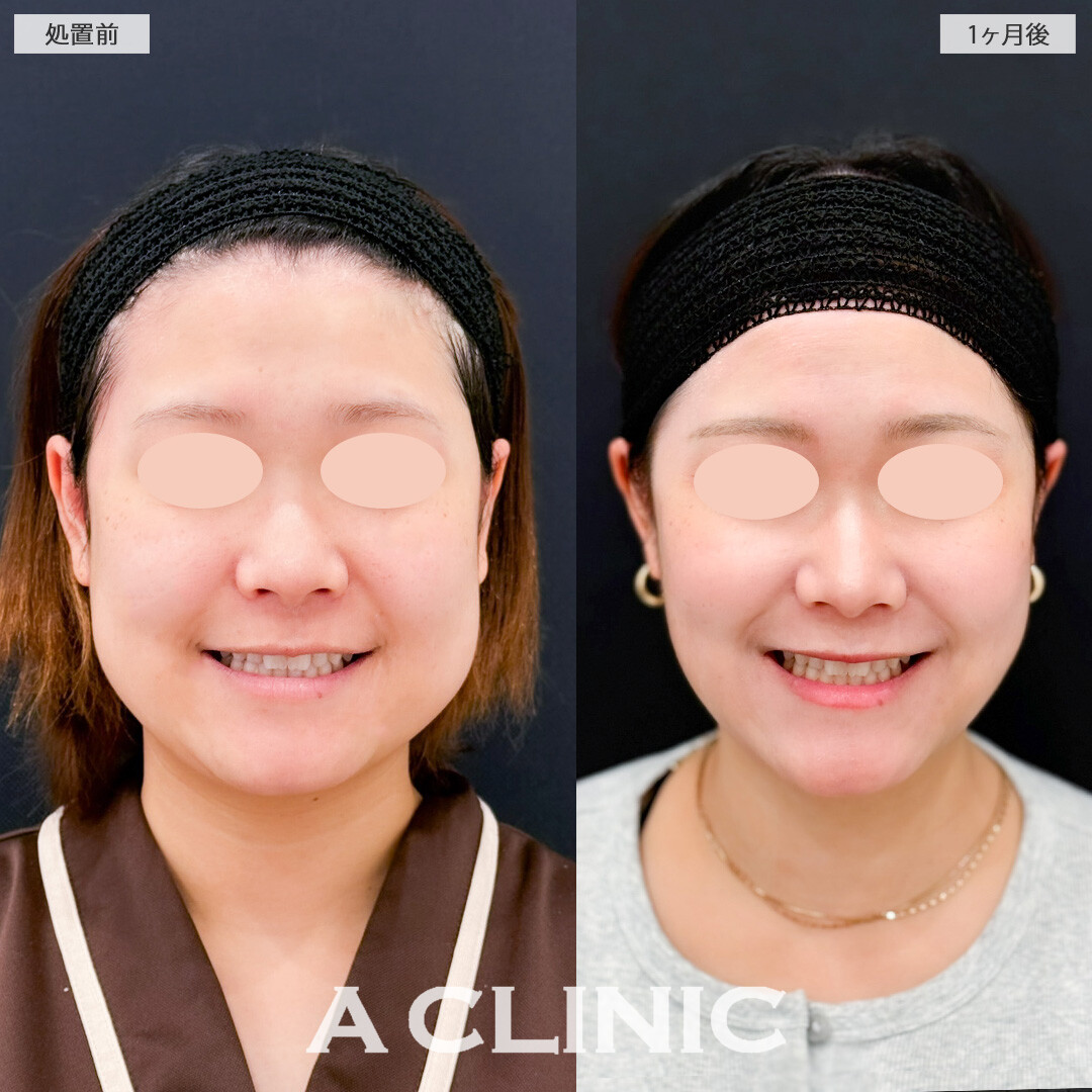 1day小顔脂肪吸引とバッカルファット除去術で加工後のような理想のフェイスラインに！こちら処置前と1か月後の症例です(20代女性)