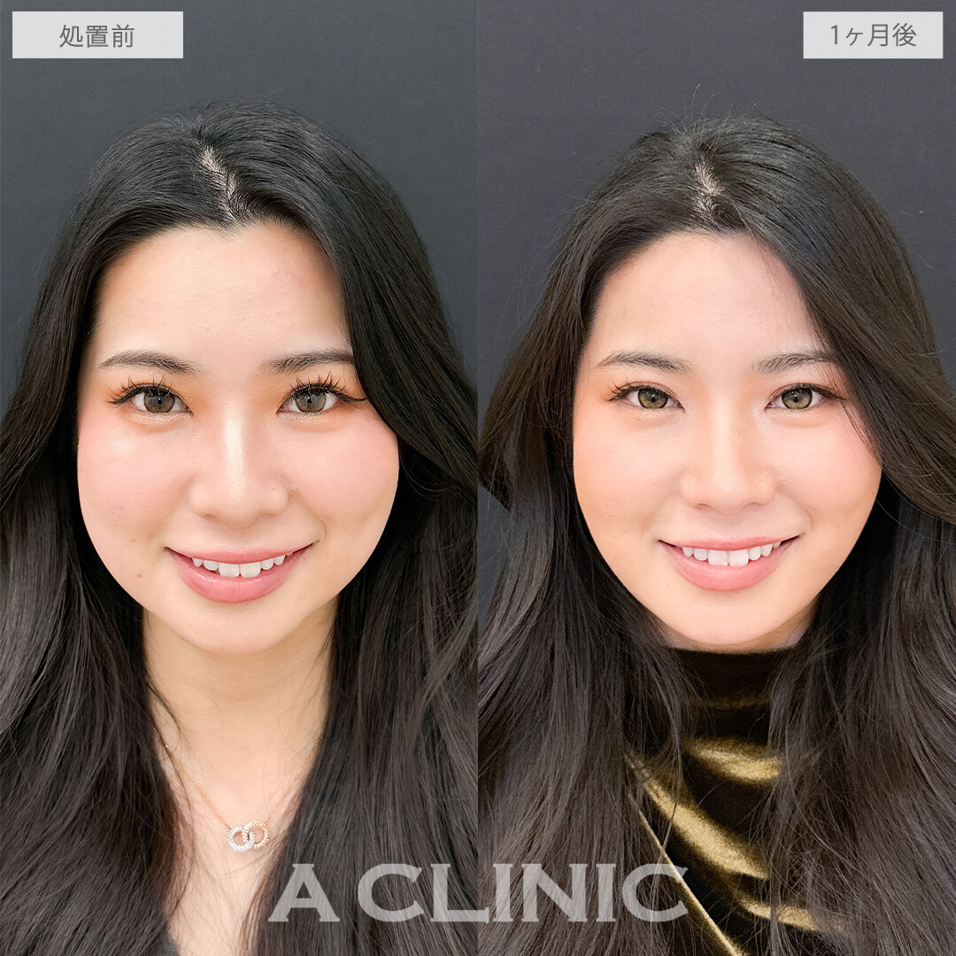 1day小顔脂肪吸引とバッカルファット除去術でお顔のボリューム感を落としてさらに美人に！こちら処置前と1か月後の症例です(20代女性)