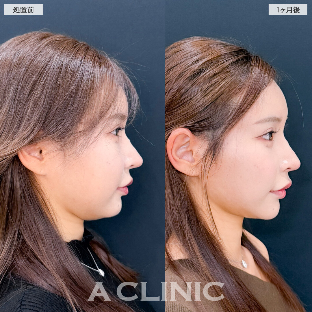 1day小顔脂肪吸引で美しいVフェイスに！こちら処置前と1ヶ月後の症例です(20代女性)