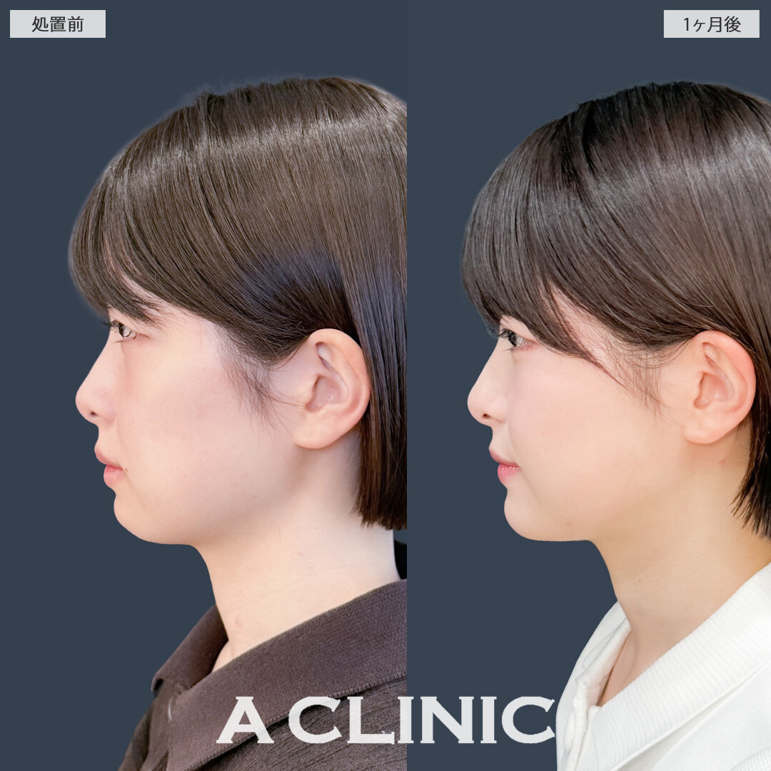 1day小顔脂肪吸引で自然に小顔になってかわいくなりました！こちら処置前と1か月後の症例です(20代女性)