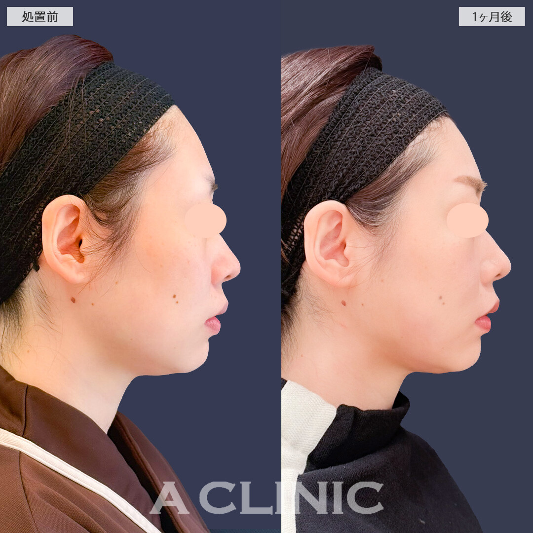 1day小顔脂肪吸引で輪郭きれいにアゴ下の脂肪も減りました！こちら処置前と1ヶ月後の症例です(30代女性)