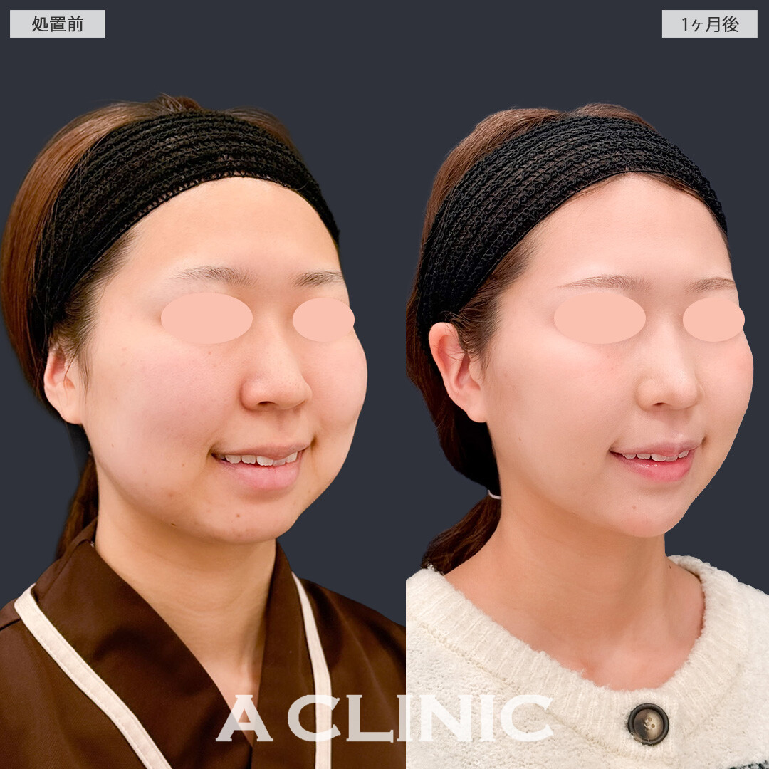 1day小顔脂肪吸引とバッカルファット除去術で必要な脂肪は残したまましっかりきれいな小顔になれました！こちら処置前と1か月後の症例です(20代女性)
