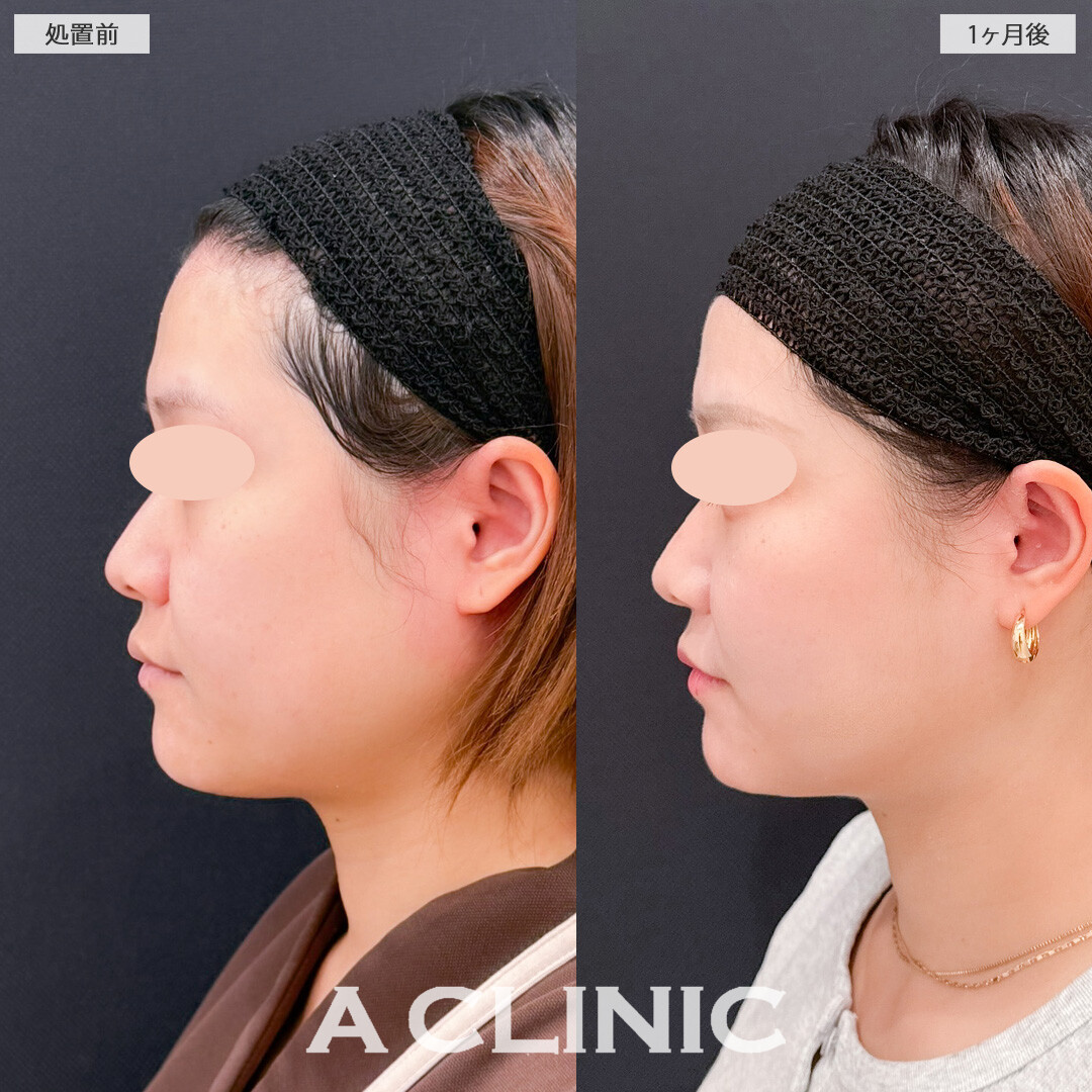 1day小顔脂肪吸引とバッカルファット除去術で加工後のような理想のフェイスラインに！こちら処置前と1か月後の症例です(20代女性)