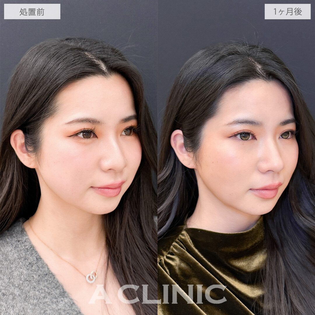 1day小顔脂肪吸引とバッカルファット除去術でお顔のボリューム感を落としてさらに美人に！こちら処置前と1か月後の症例です(20代女性)