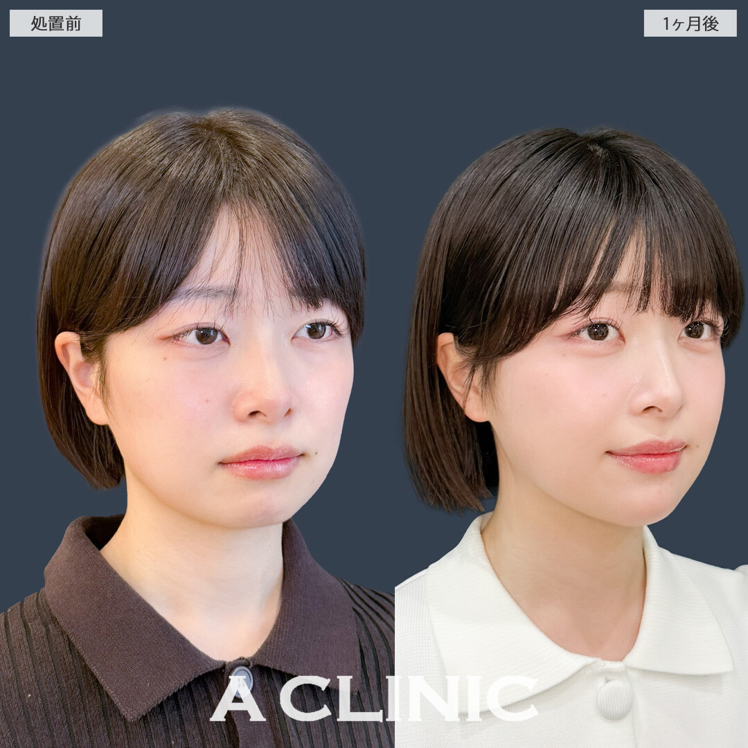 1day小顔脂肪吸引で自然に小顔になってかわいくなりました！こちら処置前と1か月後の症例です(20代女性)