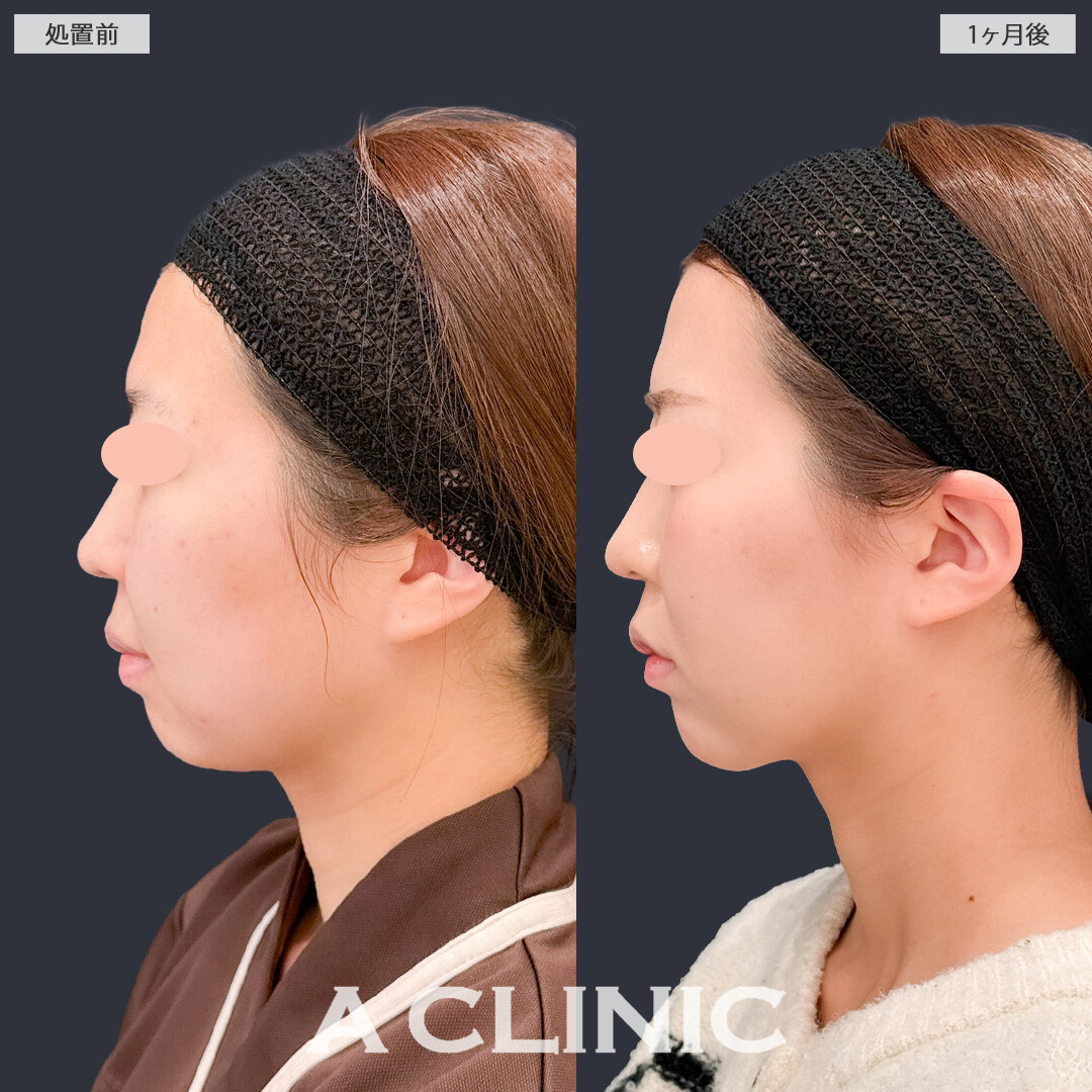 1day小顔脂肪吸引とバッカルファット除去術で必要な脂肪は残したまましっかりきれいな小顔になれました！こちら処置前と1か月後の症例です(20代女性)