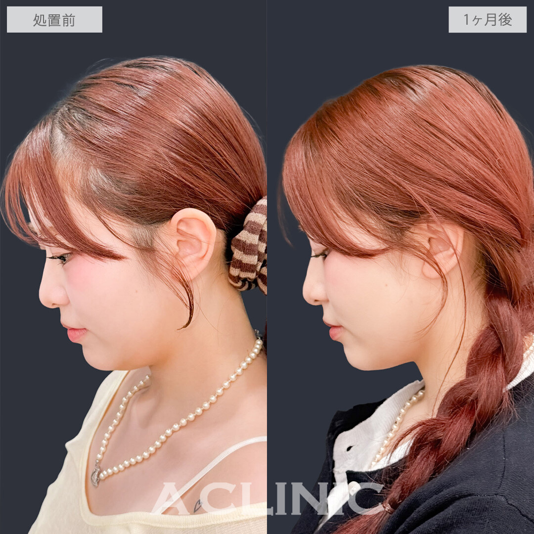 1day小顔脂肪吸引でフェイスラインが整って洗練された可愛さに！こちら処置前と1か月後の症例です(20代女性)