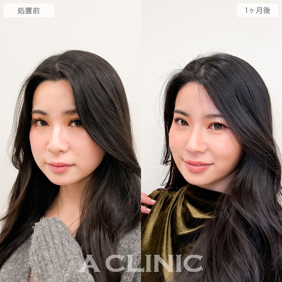1day小顔脂肪吸引とバッカルファット除去術でお顔のボリューム感を落としてさらに美人に！こちら処置前と1か月後の症例です(20代女性)
