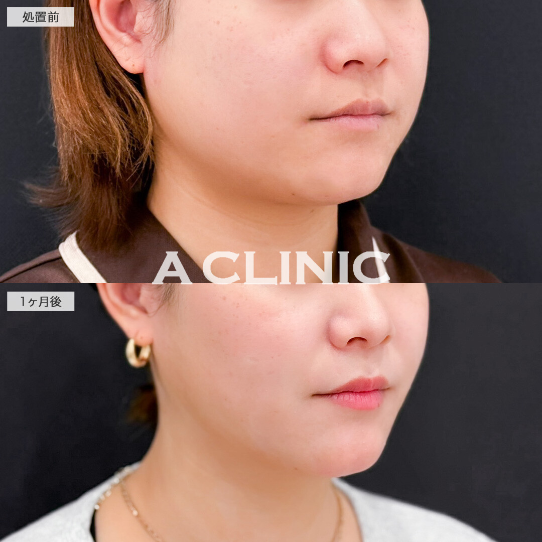 1day小顔脂肪吸引とバッカルファット除去術で加工後のような理想のフェイスラインに！こちら処置前と1か月後の症例です(20代女性)