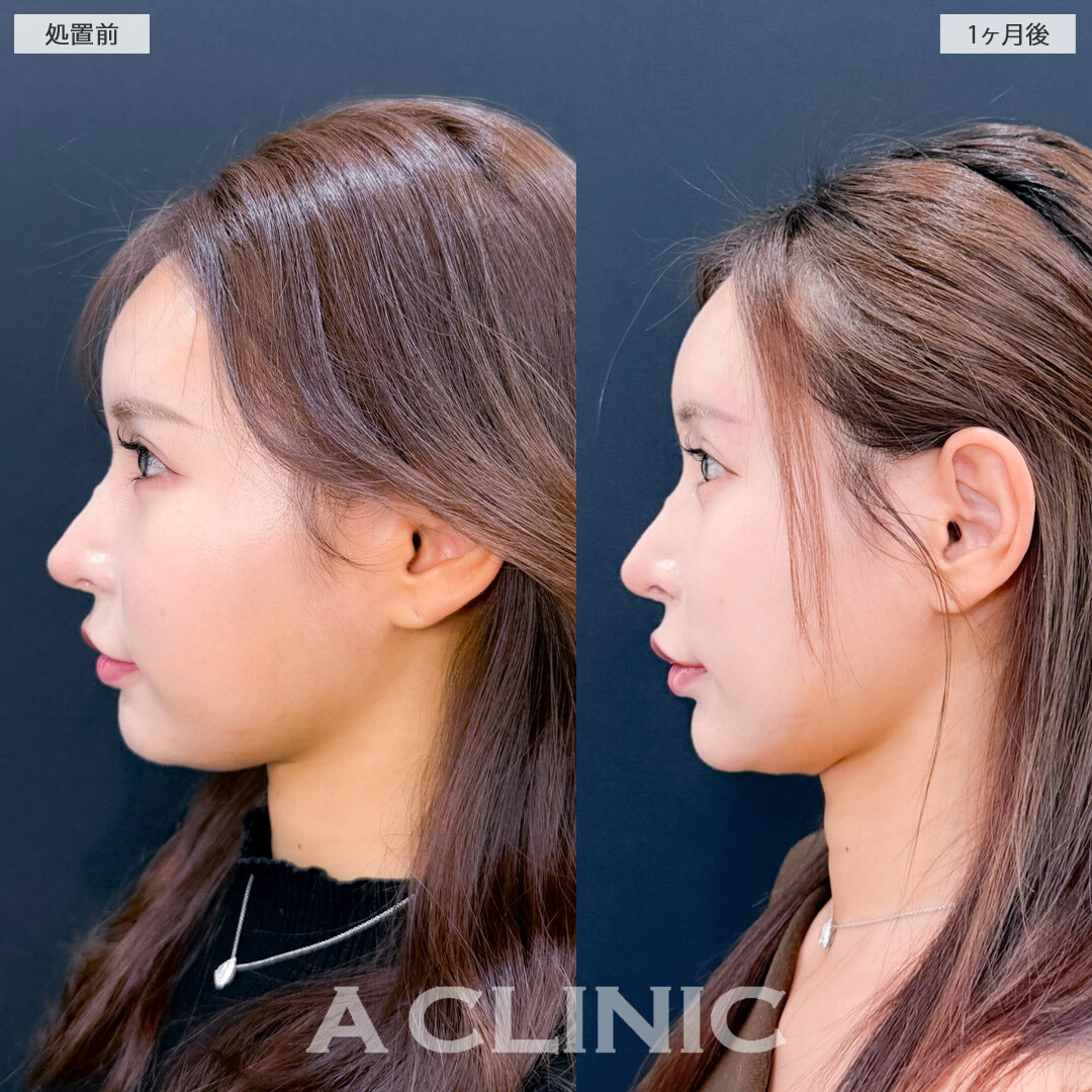 1day小顔脂肪吸引で美しいVフェイスに！こちら処置前と1ヶ月後の症例です(20代女性)