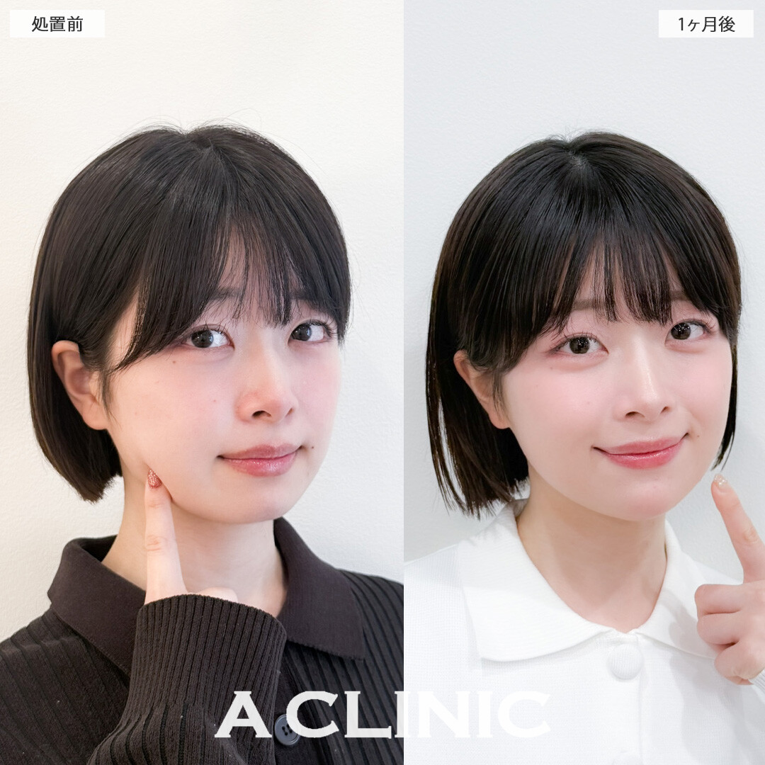 1day小顔脂肪吸引で自然に小顔になってかわいくなりました！こちら処置前と1か月後の症例です(20代女性)