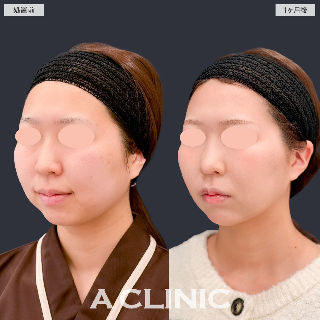 1day小顔脂肪吸引とバッカルファット除去術で必要な脂肪は残したまましっかりきれいな小顔になれました！こちら処置前と1か月後の症例です(20代女性)