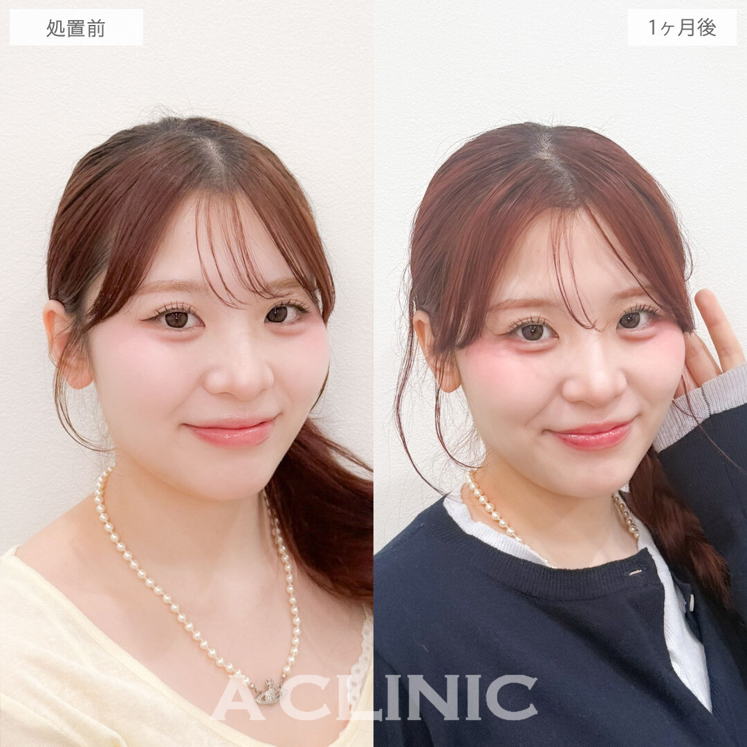 1day小顔脂肪吸引でフェイスラインが整って洗練された可愛さに！こちら処置前と1か月後の症例です(20代女性)