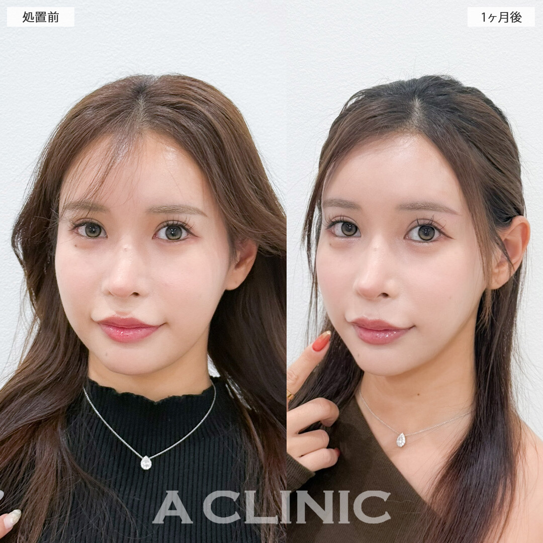 1day小顔脂肪吸引で美しいVフェイスに！こちら処置前と1ヶ月後の症例です(20代女性)