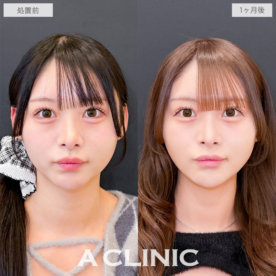 1day小顔脂肪吸引でかわいいを更新しました！こちら処置前と1か月後の症例です(20代女性)