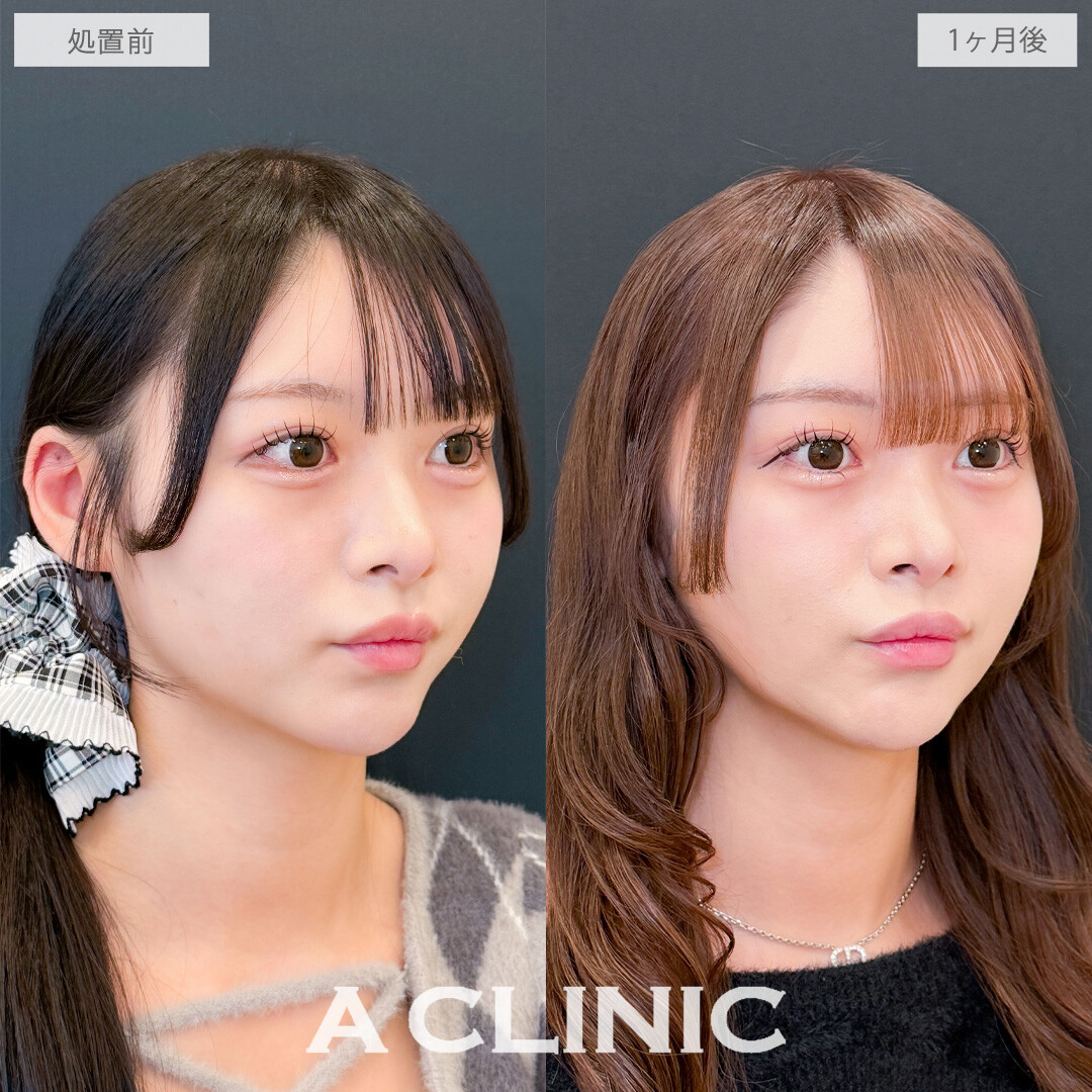 1day小顔脂肪吸引でかわいいを更新しました！こちら処置前と1か月後の症例です(20代女性)